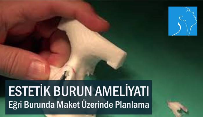 estetik-burun-ameliyati-egri-burunda-maket-uzerinde-ameliyat-planlamasi-prof-dr-teoman-dal