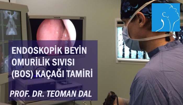 sinüzit,kronik sinüzit,sinüzit tedavisi,sinüzit ameliyatı,sinüs cerrahisi,endoskopik sinüs cerrahisi,uyku apnesi,BOS fistülü,bos fistülü ameliyatı,bos fistülü nedir,bos kaçağı ameliyatı nasıl yapılır,bos kaçağı ameliyatı sonrası