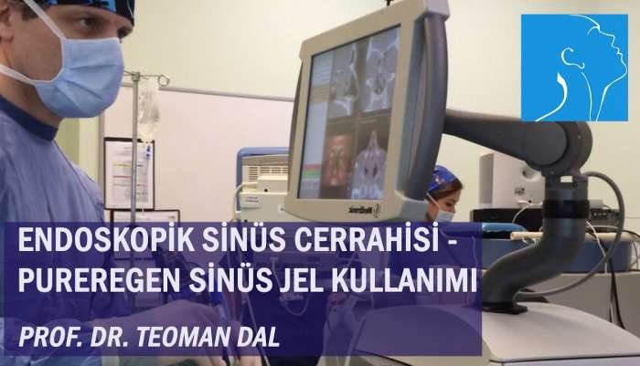 endoscopic sinus surgery,sinus surgery,Pureregen,chronic sinusitis,endoskopik sinüs cerrahisi,kronik sinüzit,sinüs ameliyatı,Dr.Teoman Dal,functional endoscopic sinus surgery,sinusitis,nazal polip,nazal polip ameliyatı,endoskopik sinüs ameliyatı,si