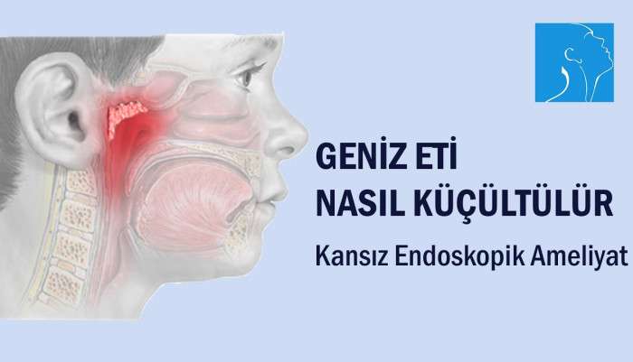Geniz eti,adenoidektomi,geniz eti ameliyatı,adenoidectomy,coblation,Koblatör ile adenoidektomi,coblation adenoidectomy,adenoid,geniz eti büyümesi,adenoid büyümesi,Dr Teoman Dal