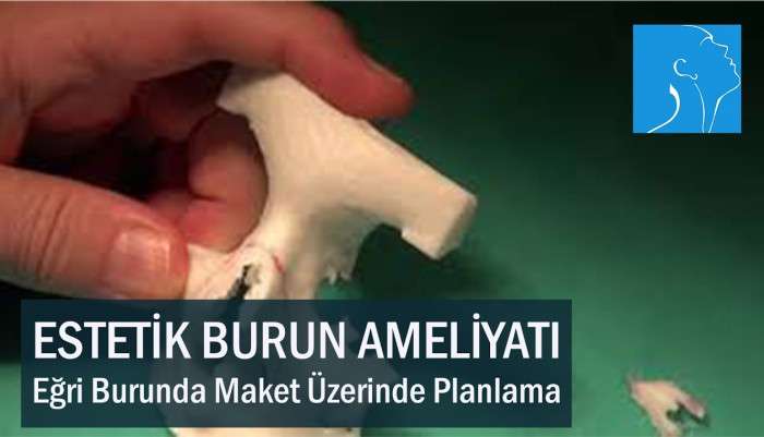 burun estetiği,rinoplasti,estetik burun ameliyatı,piezo burun estetiği,eğri burun,rhinoplasty,Dr. Teoman Dal,burun ameliyatı,preservation burun estetiği,koruyucu rino,rinoplasti planlaması,burun estetiği sonrası,burun estetiği ameliyatı,prezerv