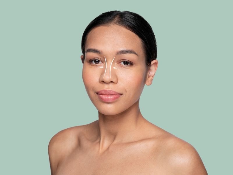 rinoplastide-kikirdak-grefti-nedir